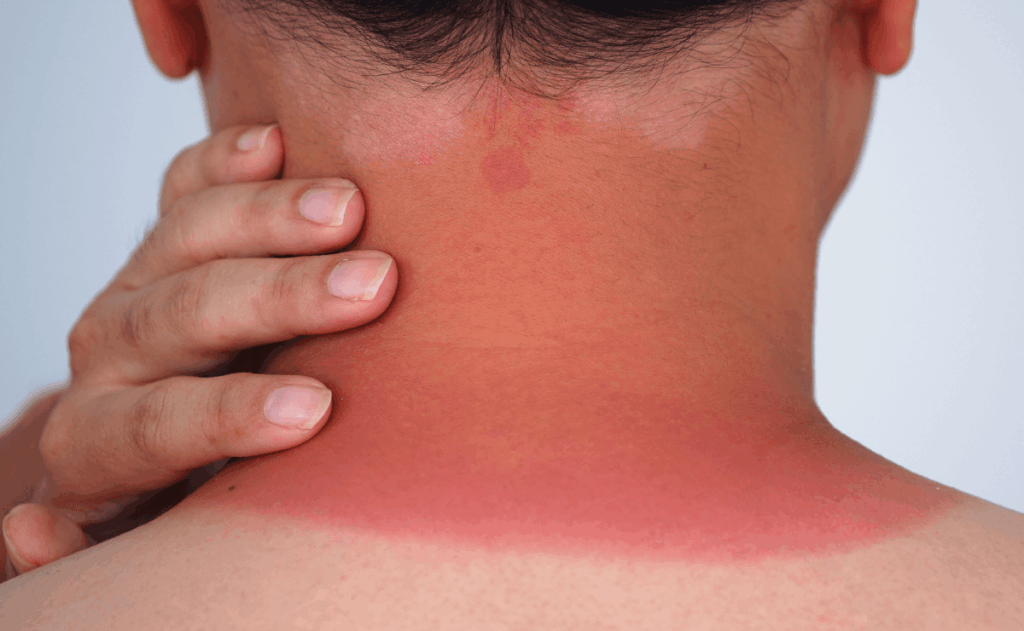 rimedi naturali per le scottature solari